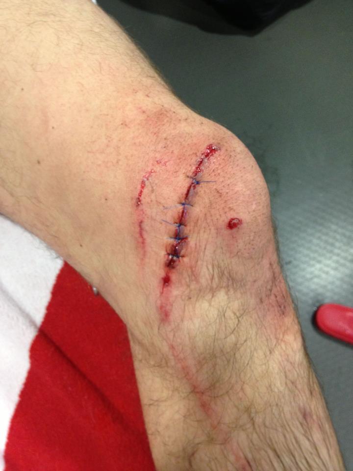世界杯欧预赛尤努佐维奇膝盖受伤