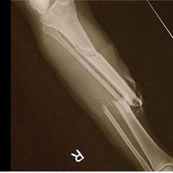 保罗-乔治右小腿X光成像.