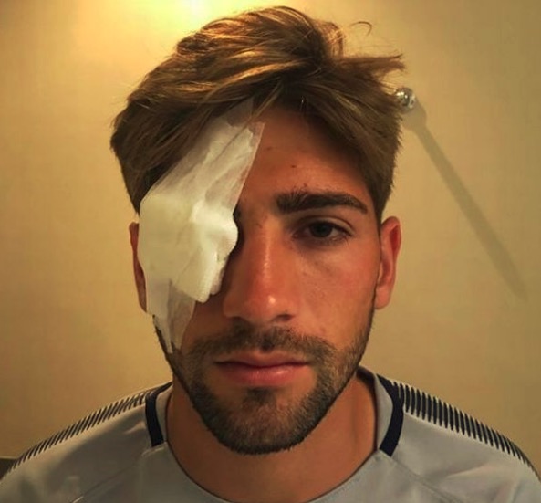 由于一块碎玻璃进入眼睛,他的角膜出现了溃疡,拉玛尔多的右眼也被包扎