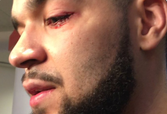 范弗利特比赛中左眼受伤，需要伤口缝合治疗