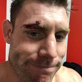 硬汉米队！米尔纳眉骨破裂缝针两次，仍踢了60分钟