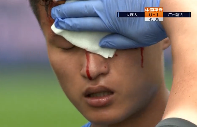 GIF：硬碰硬！林良铭与弋腾接触后眉骨破裂无法坚持